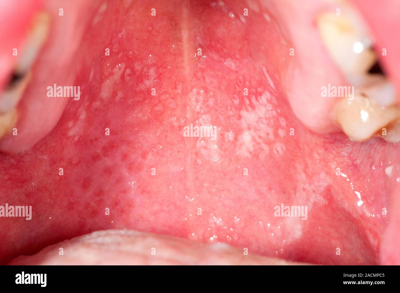 Closeup of white spots on the palate of the mouth in a 60 year old