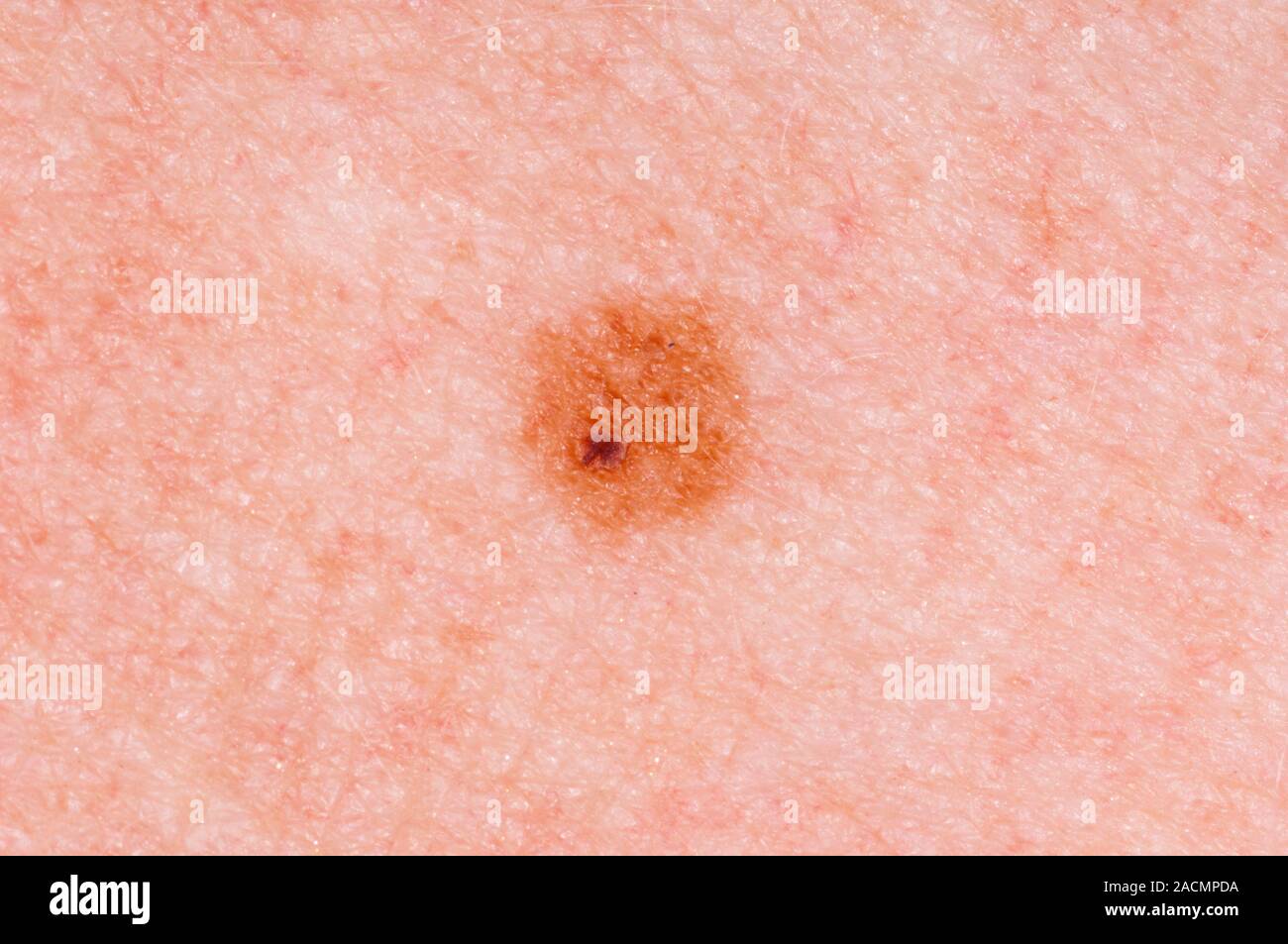 Junctional Naevus Mole On The Skin Stock Image C013 Moles melanocytic