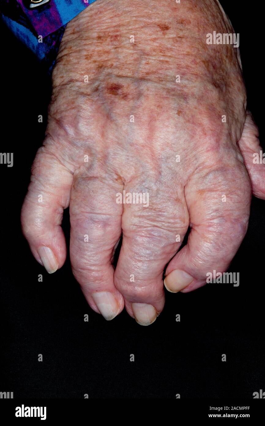 Swollen and deformed hand and fingers in a 96 year old female patient due to osteoarthritis, a