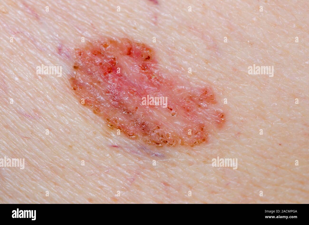 Close Up Of Superficial Spreading Basal Cell Carcinoma Bcc On The Skin Of The Back In A