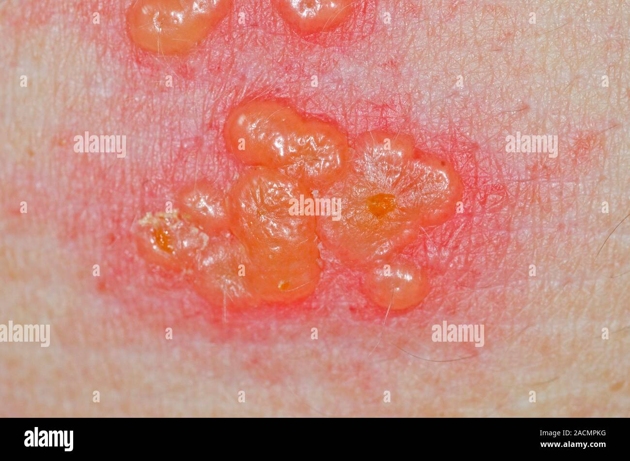 Close-up of a rash of blisters on the skin in a 58 year old female ...