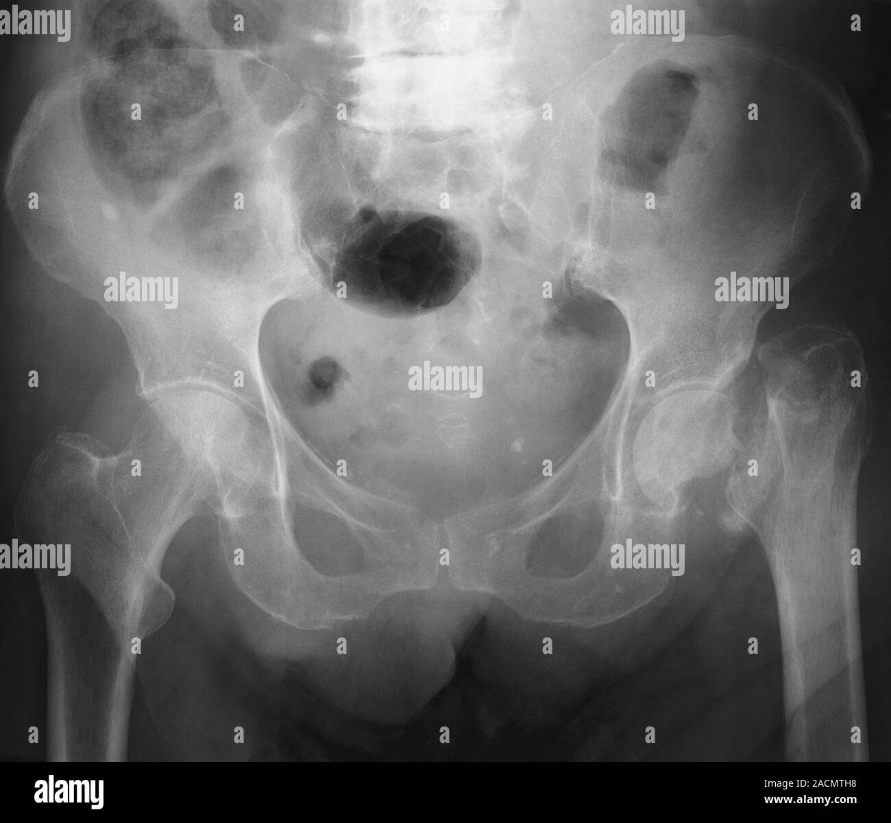 Fractured hip. Frontal X-ray of the pelvis of an 89-year-old patient ...