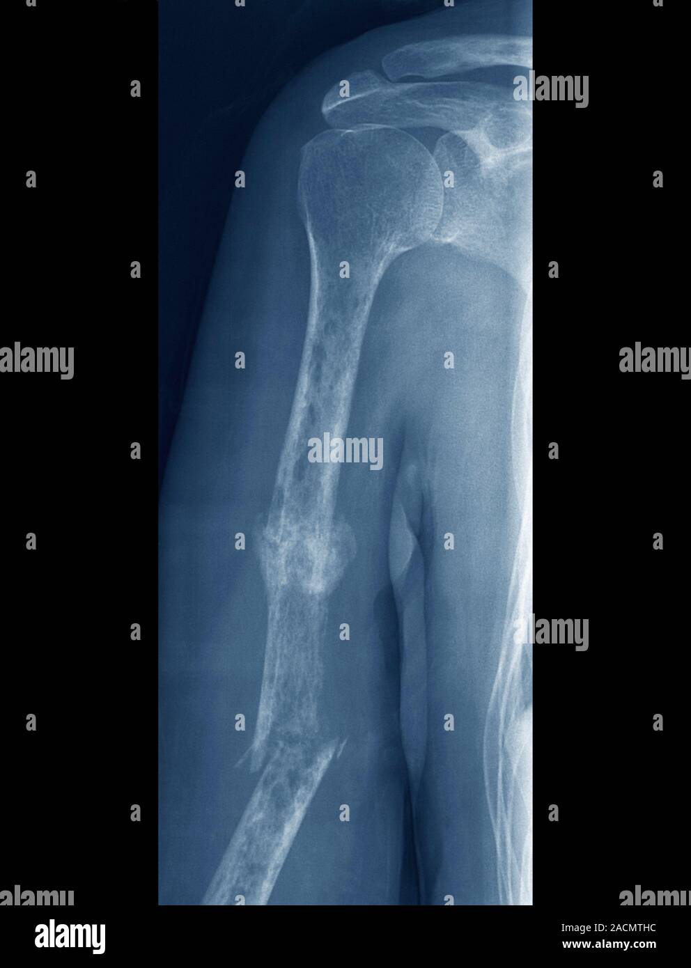 Fractures and bone cancer. Frontal Xray of the right arm of a 63year
