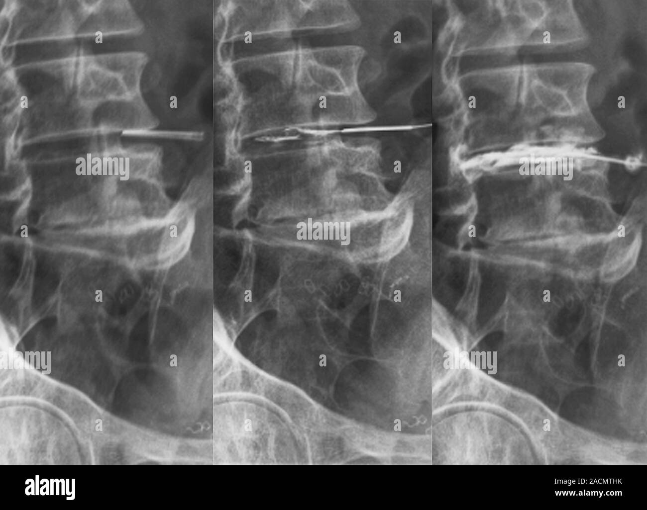 Sciatica treatment. Xrays of the lumbar (lower back) spine of a 48