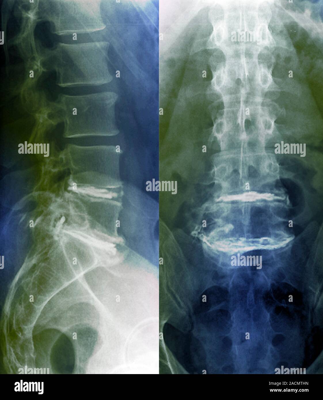 Sciatica. Coloured X-rays of the lumbar (lower back) spine of a 48-year ...