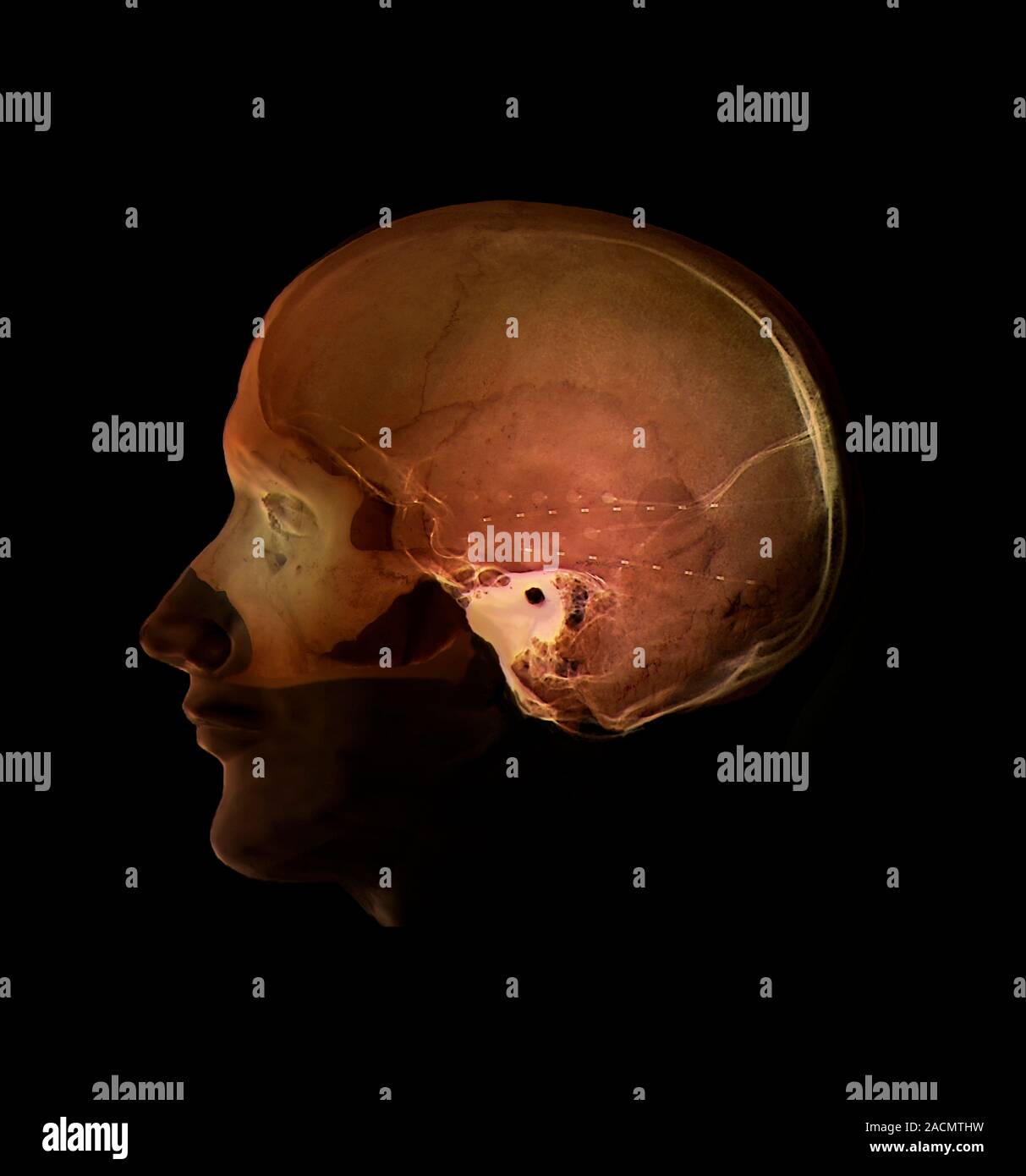 Epilepsy electrode implants. 3D model of the skull of a 27yearold