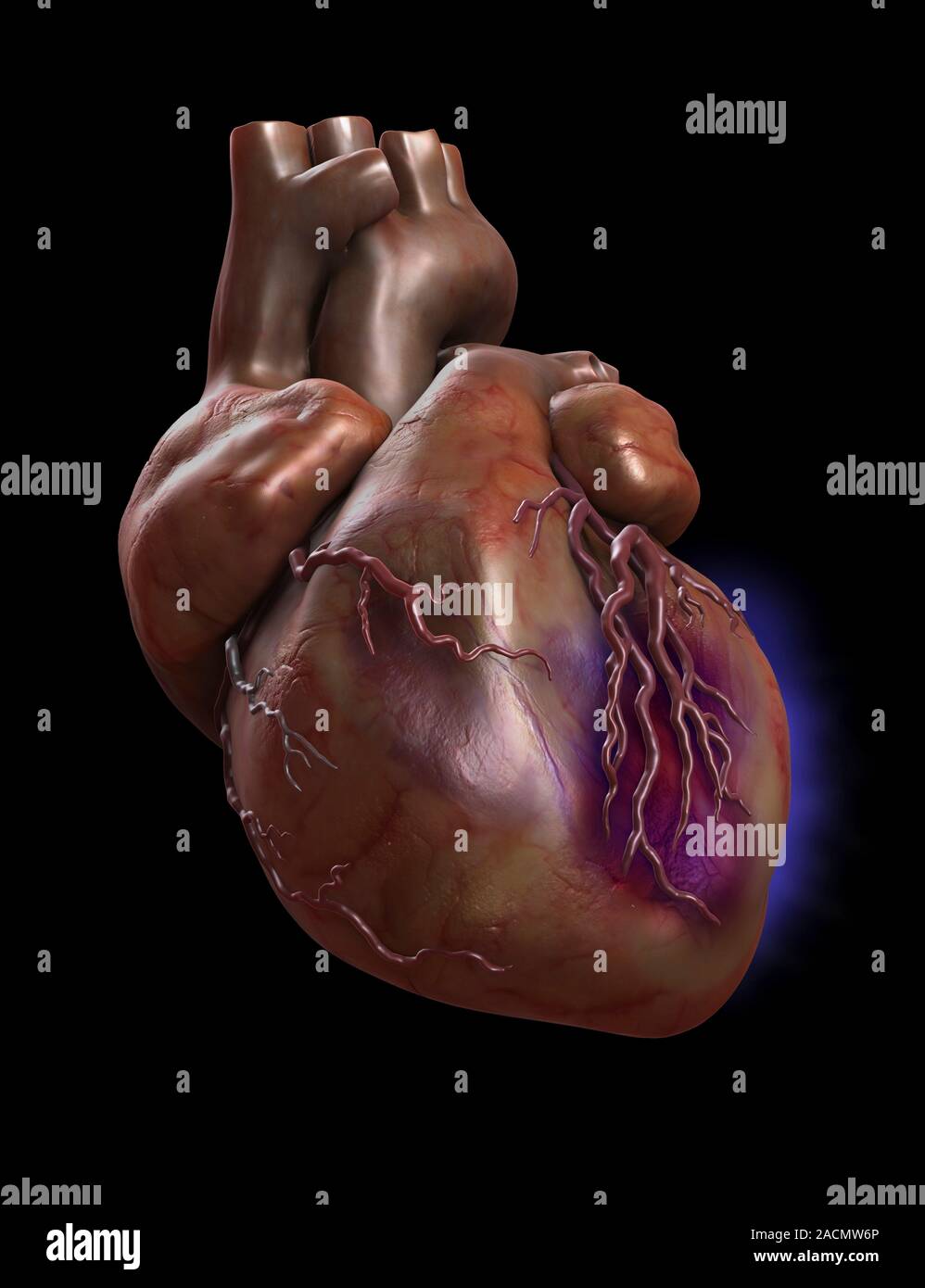 Heart Attack, Conceptual Image. A Heart Attack Results From The 