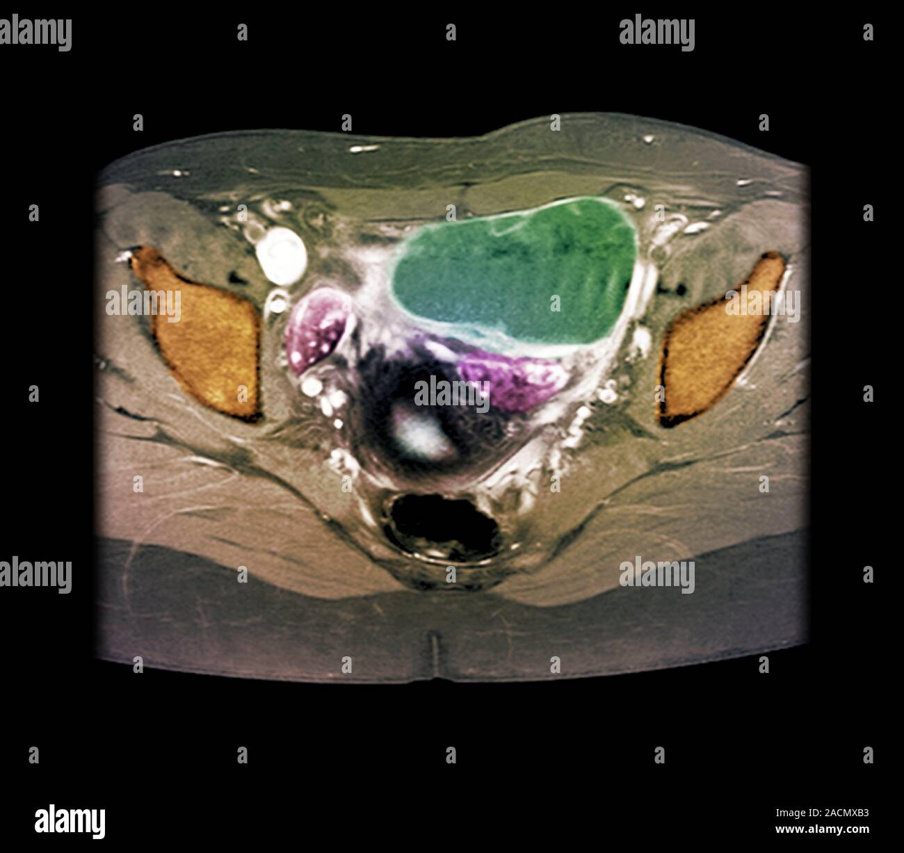 Ovarian cyst. Xray of a section through the pelvic region of a 29year