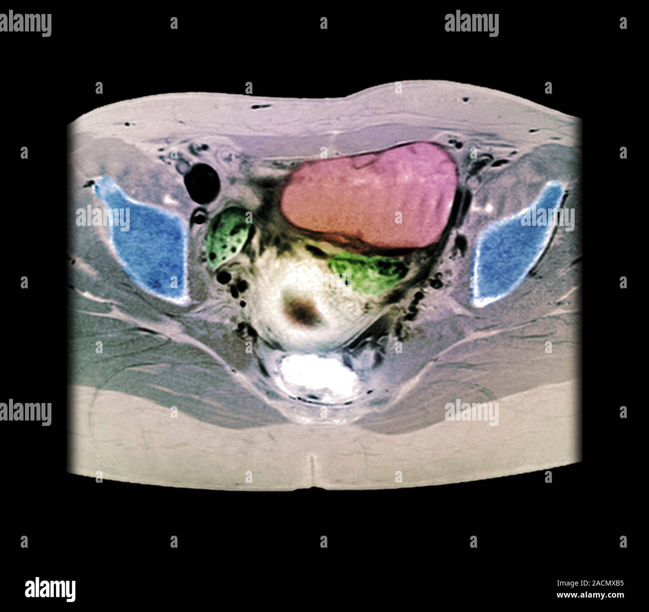 Ovarian cyst. X-ray of a section through the pelvic region of a 29-year ...