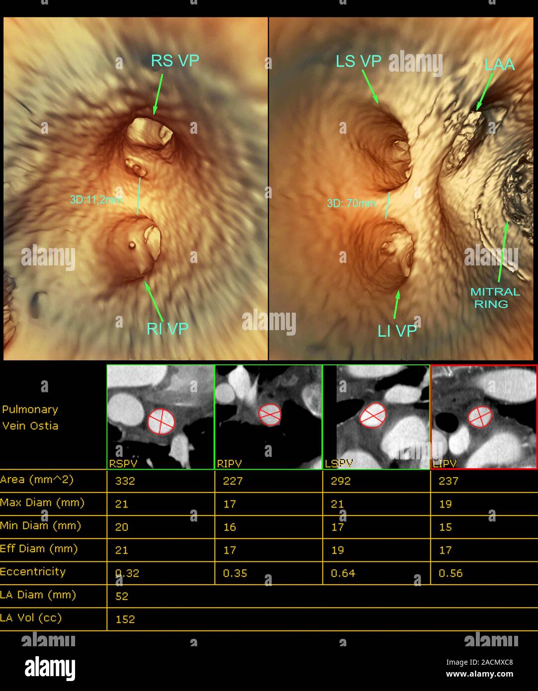 Internal heart anatomy, coloured 3D computed tomography (CT) scans ...
