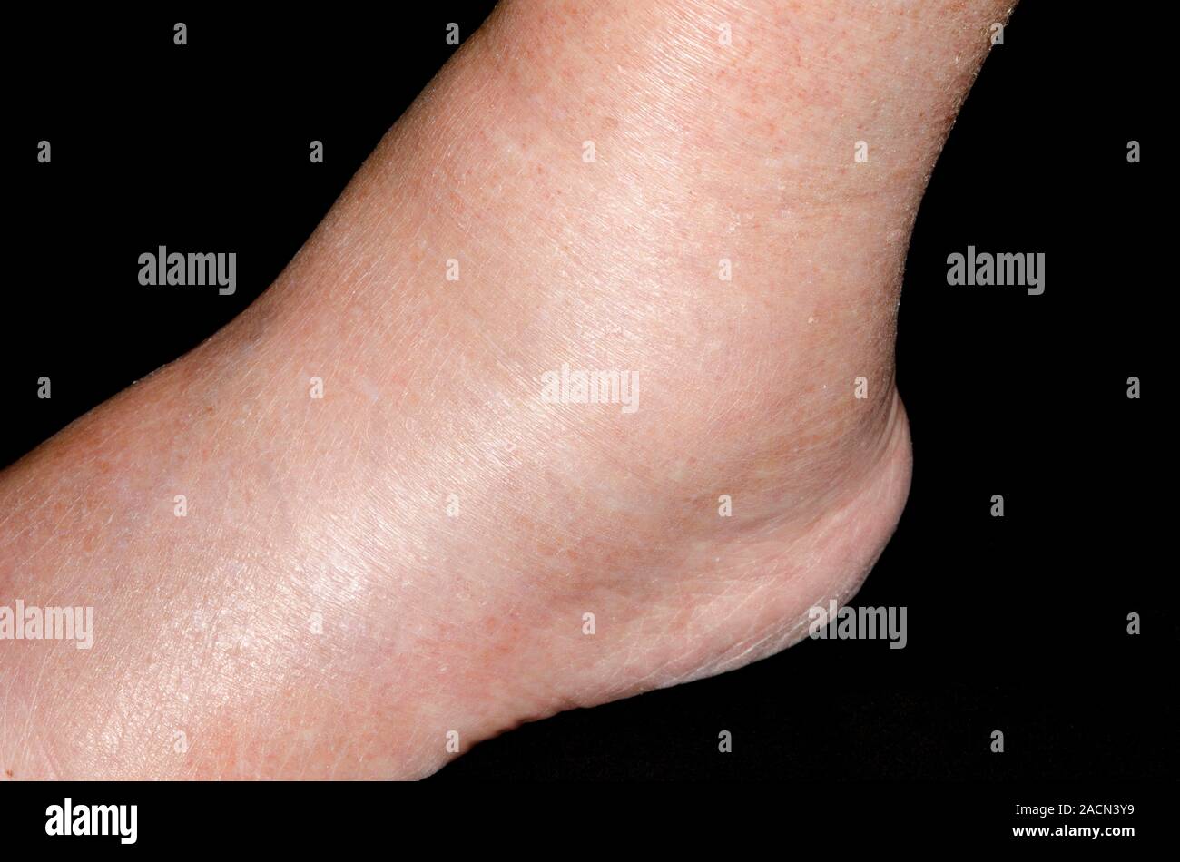 Swelling (oedema) of the ankle in a 79 year old female patient, a side