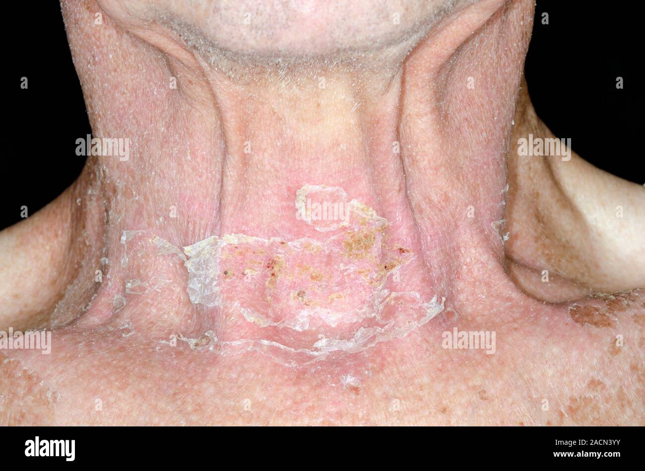Skin damage (desquamation) on the neck in an 81 year old male patient