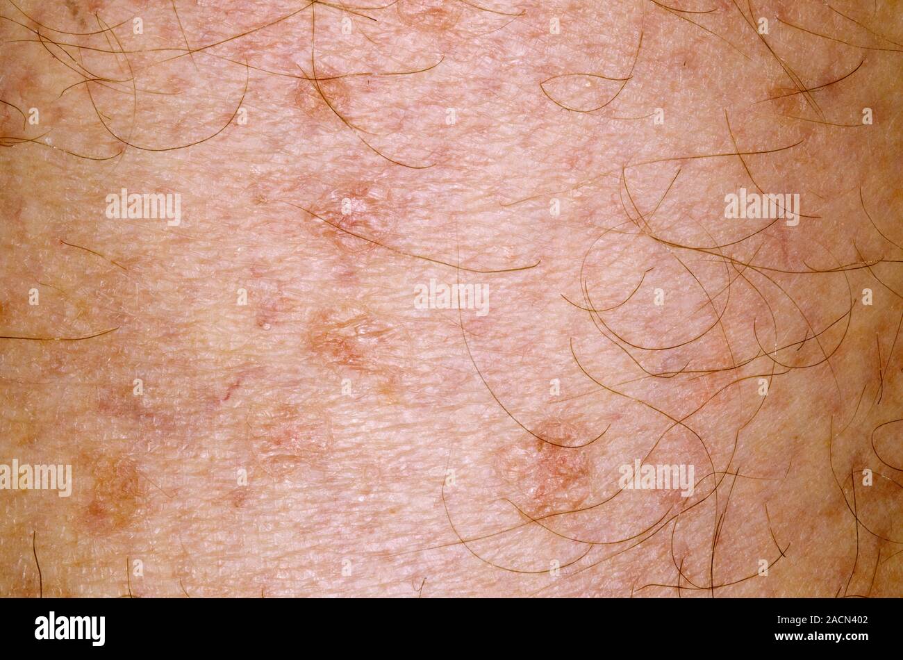 Macular skin rash on the leg in an 84 year old male patient as a