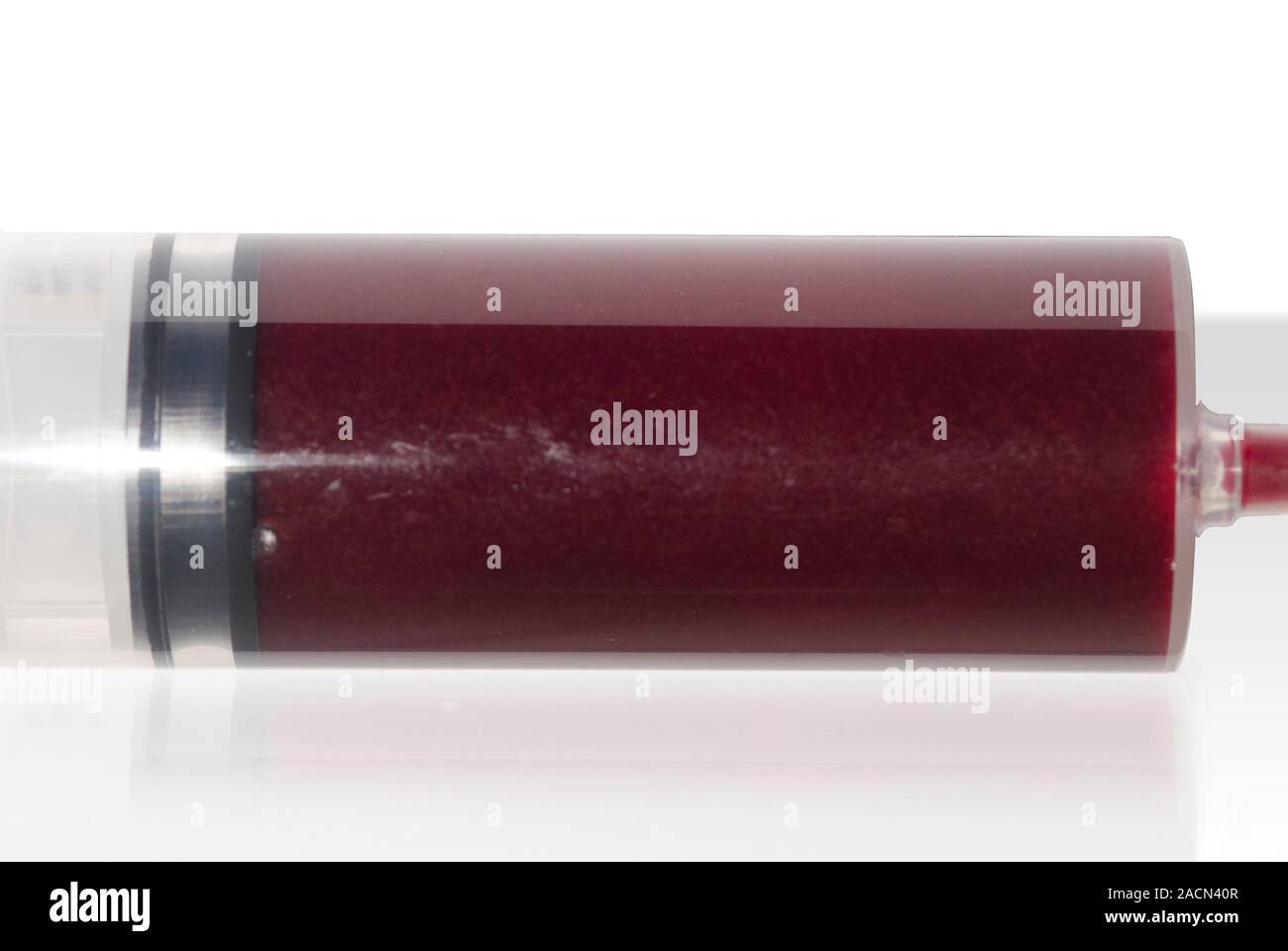 Syringe containing blood aspirated from the knee joint of a 16 year old