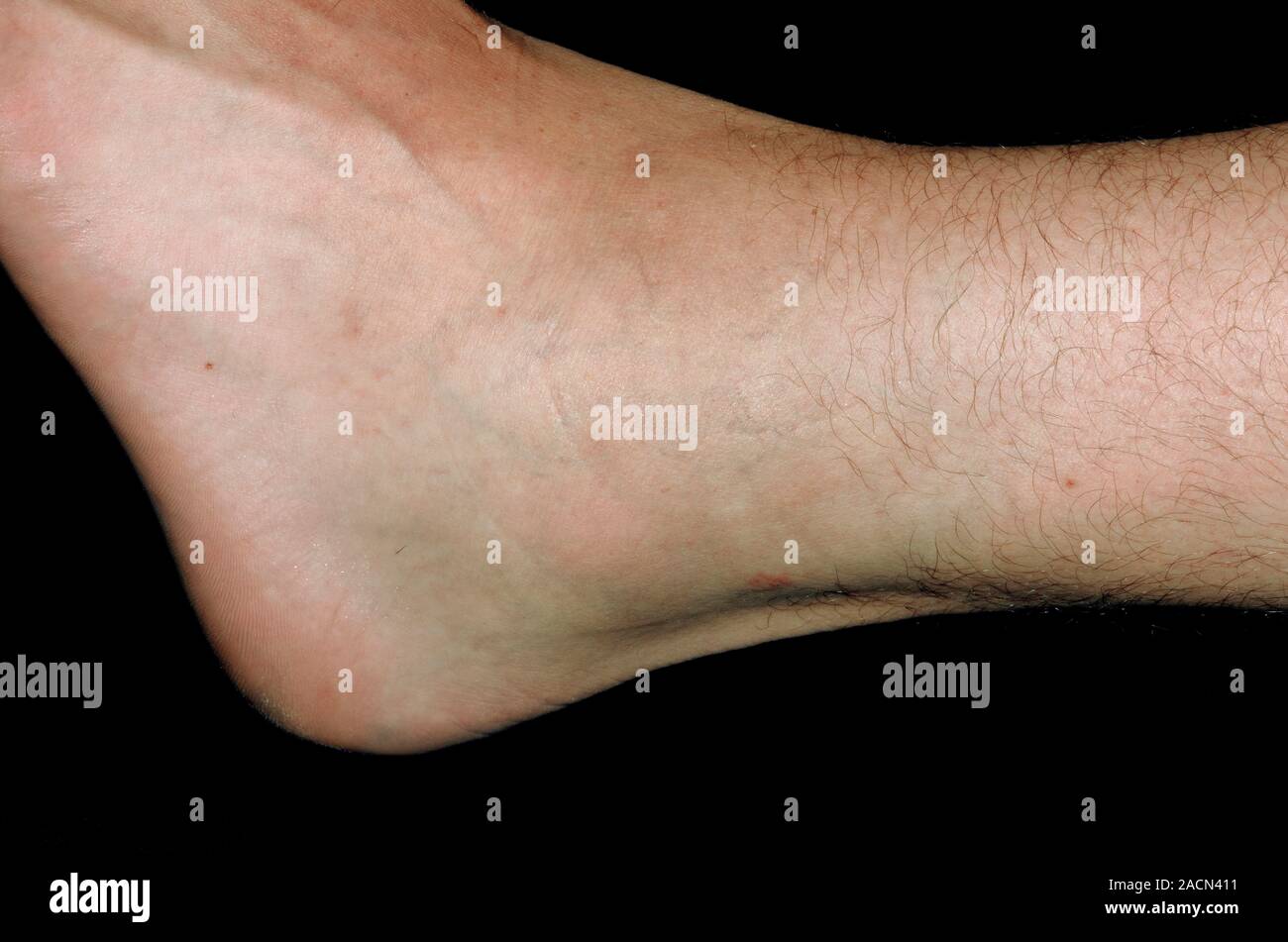Inflammation and bruising around a sprained ankle in a 23 year old male