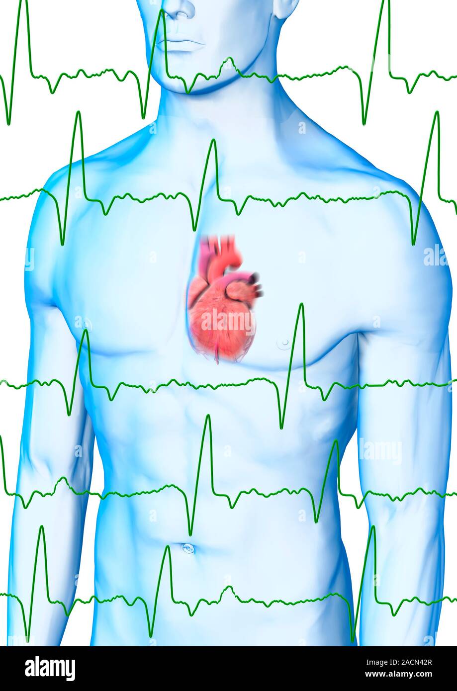 Irregular heart beat, conceptual image. Computer artwork of ECG ...