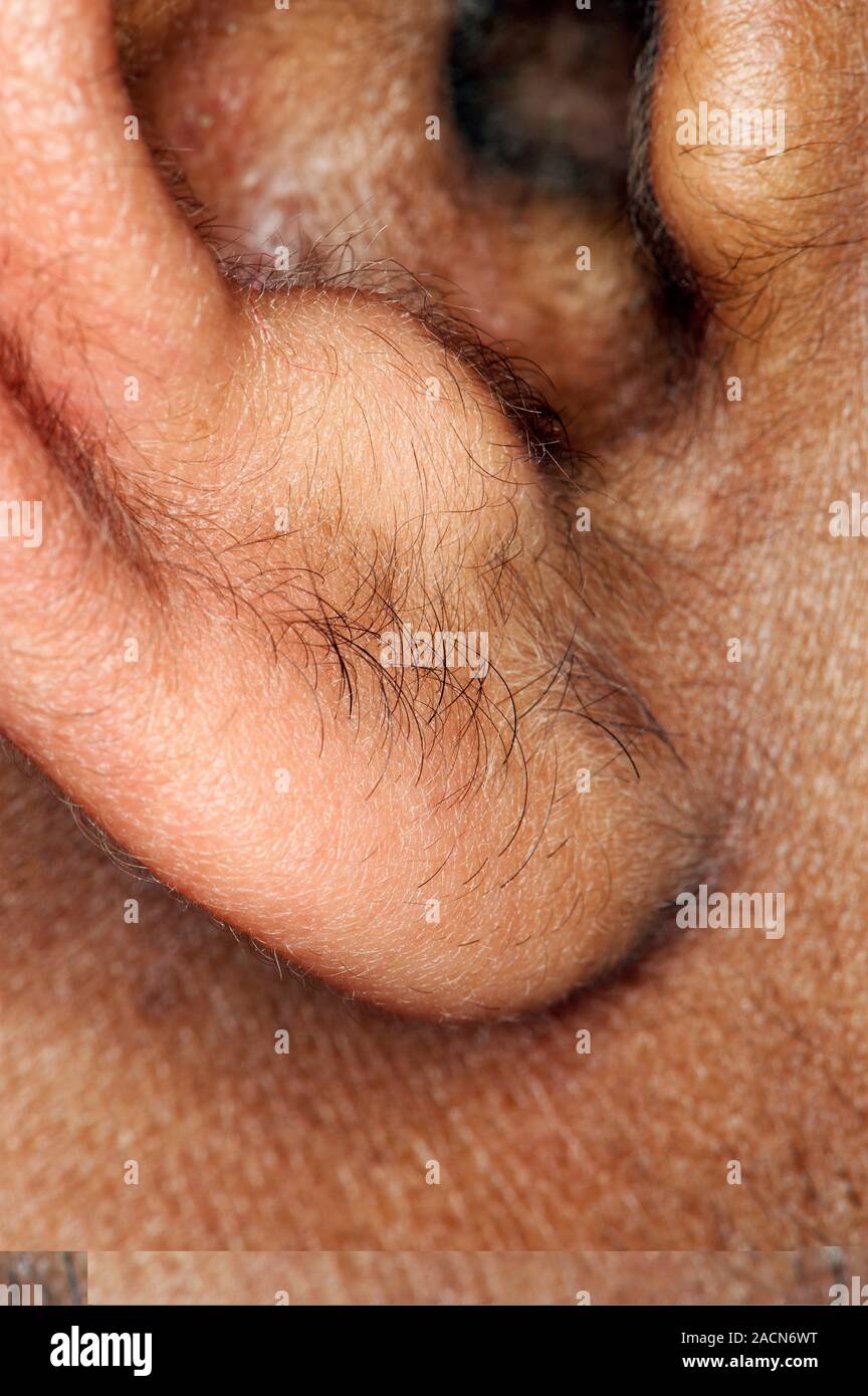 Lobulus Ear Human ear lobe. Close-up of the lobule (ear lobe) of a 24-year-old man ...