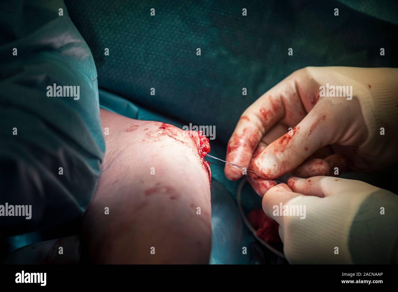 Elbow surgery. Closeup of a surgeon closing the wound in a patient's