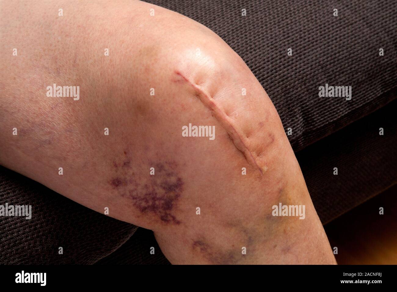 Knee surgery scar. Three-week- old scar on the knee of a 75-year-old ...