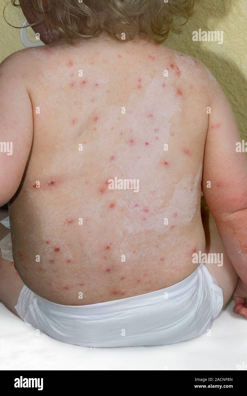 Not for use in Television Not for use in Television Rash of chicken pox