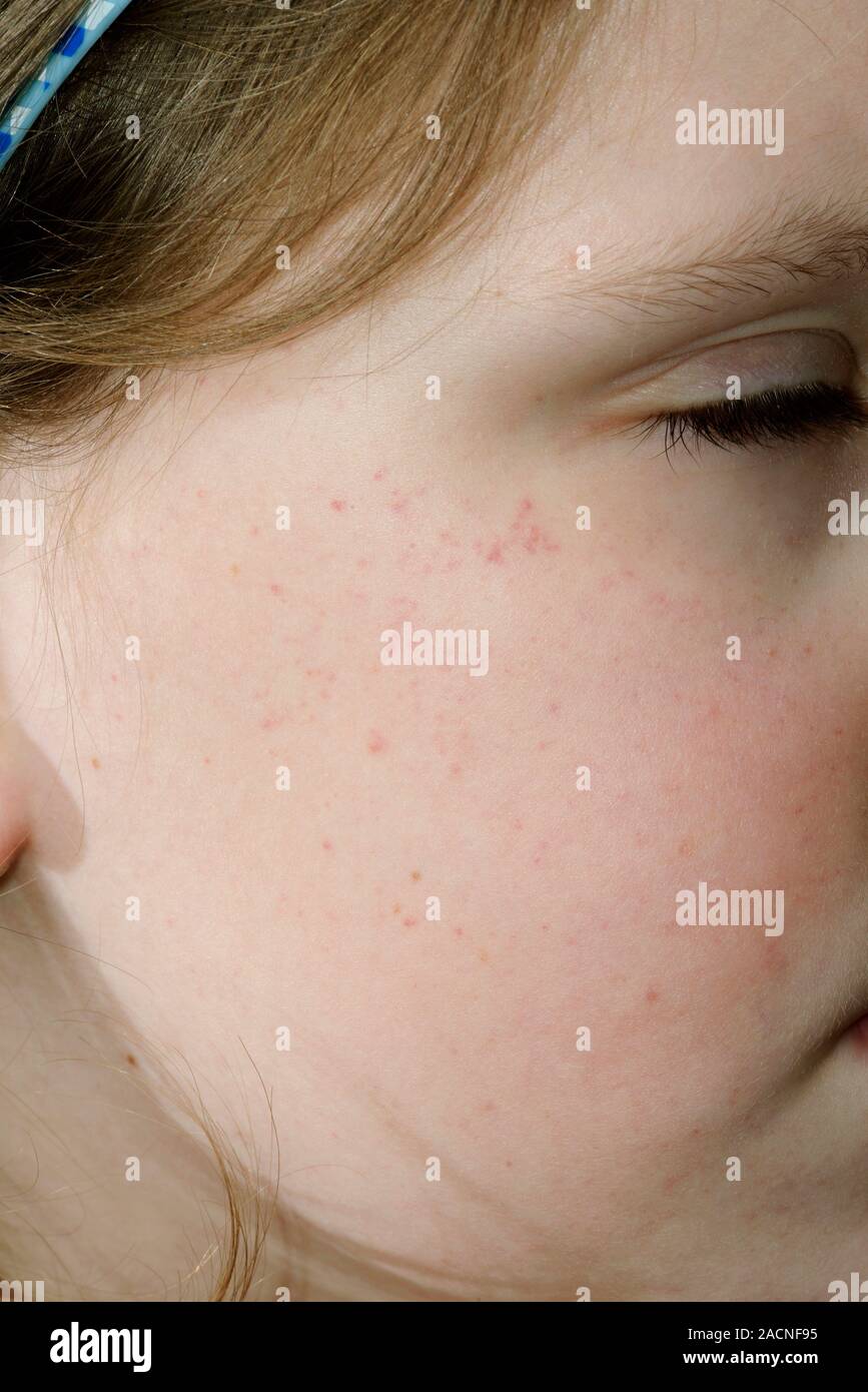 Not for use in Television Not for use in Television Small spots ...