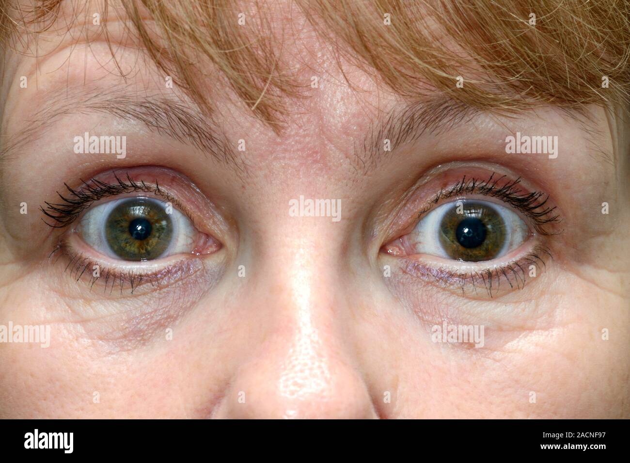 анизокория зрачков