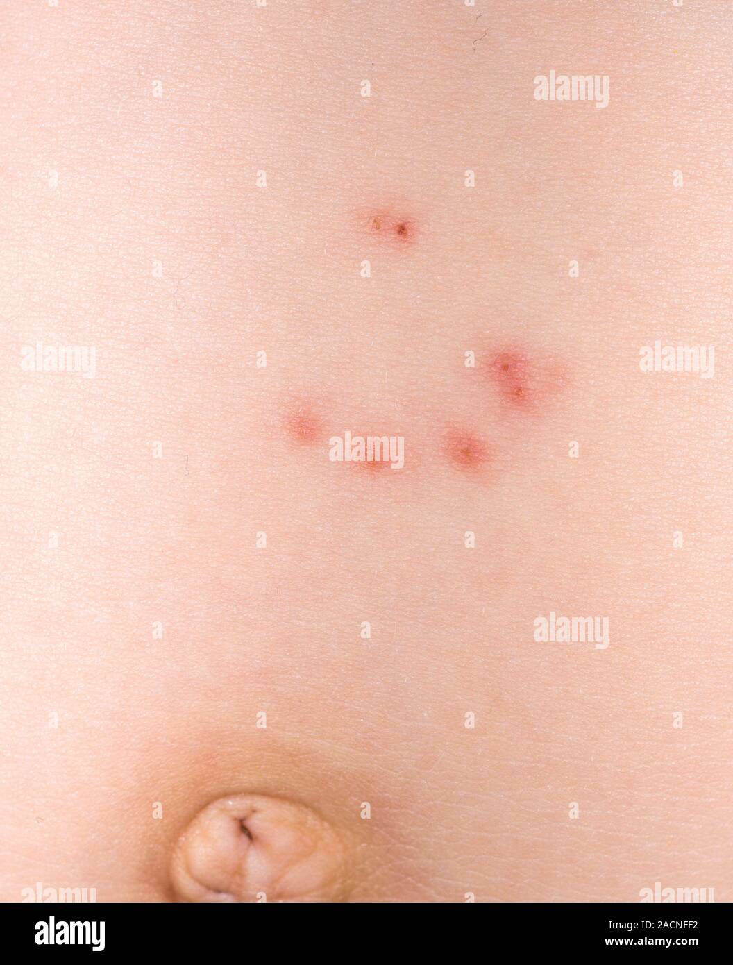 Close-up of red sores on the skin of the abdomen in a young patient ...