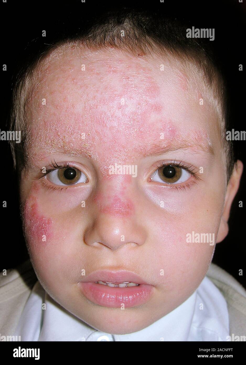 Red patches on the skin of the face in a young male patient due to ...