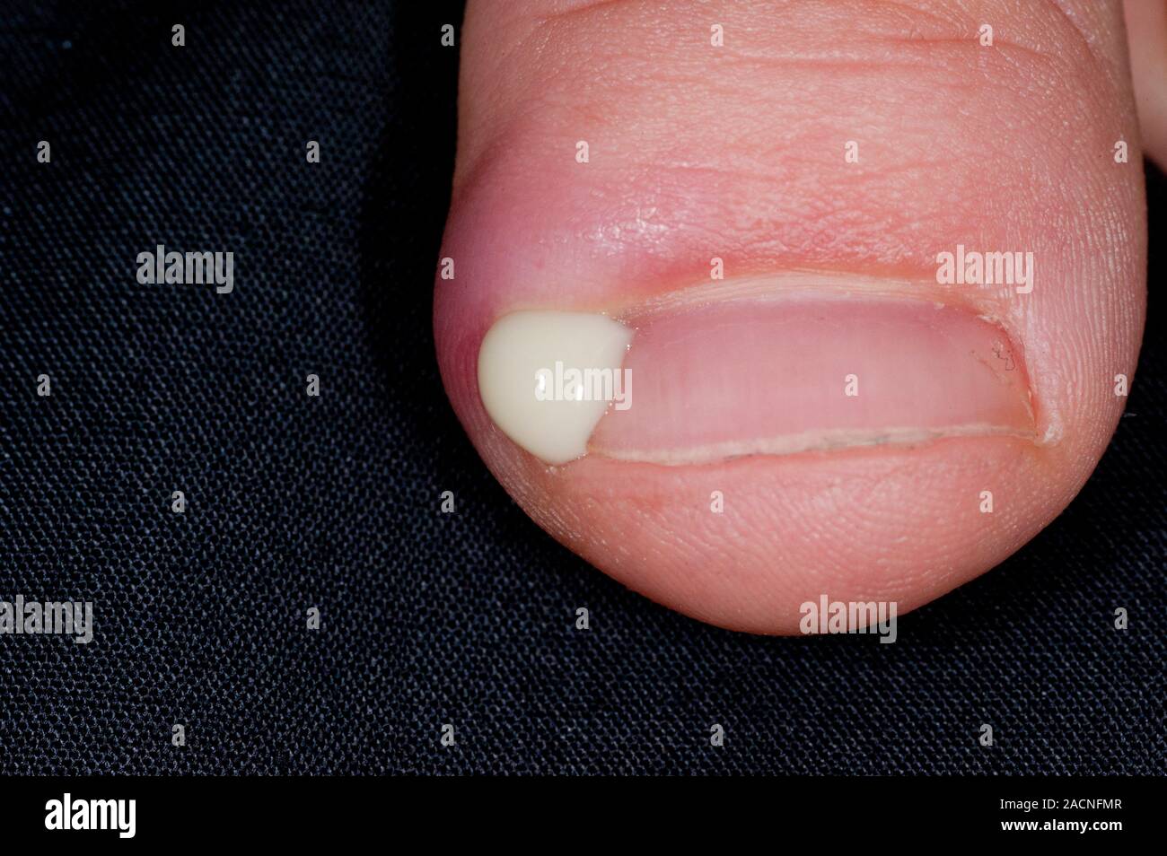 Close-up of pus released from under the skin due to an infection around the fingernail in a 14 year old male patient. This skin inflammation and infec Stock Photo - Alamy Close-up of pus released from under the skin due to an infection around the fingernail in a 14 year old male patient. This skin inflammation and infec Stock Photo - Alamy