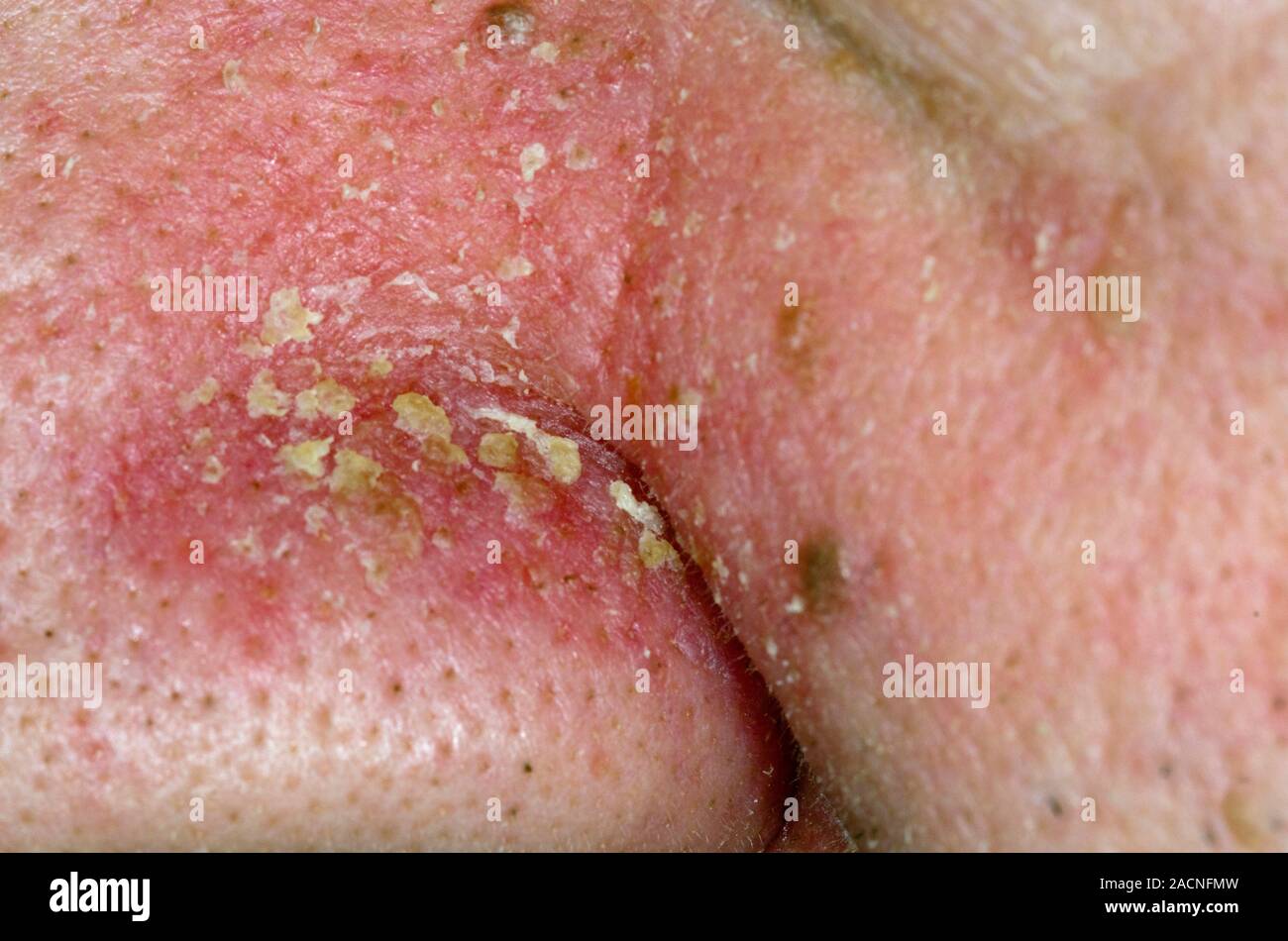 Closeup of seborrhoeic dermatitis on the nose in a 65 year old male patient. Seborrhoeic