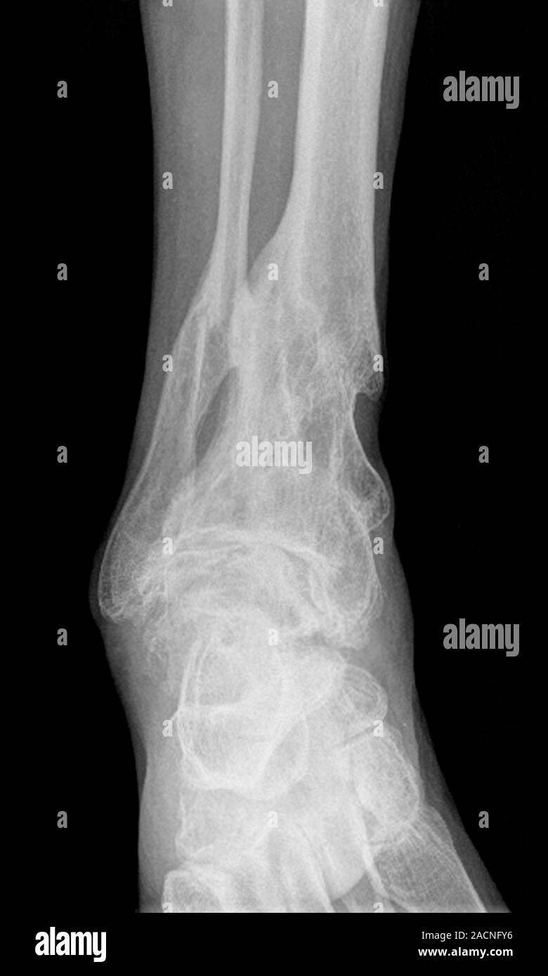 X-ray (front view) of the ankle in a 71 year old male patient with ...