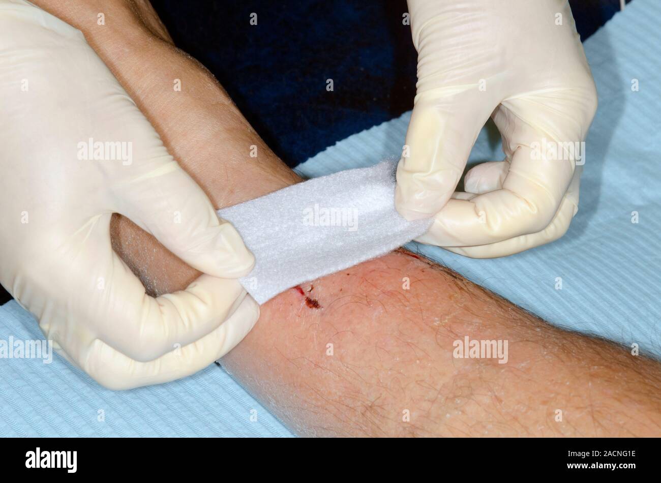 Gloved hands place a gauze dressing on an infected laceration
