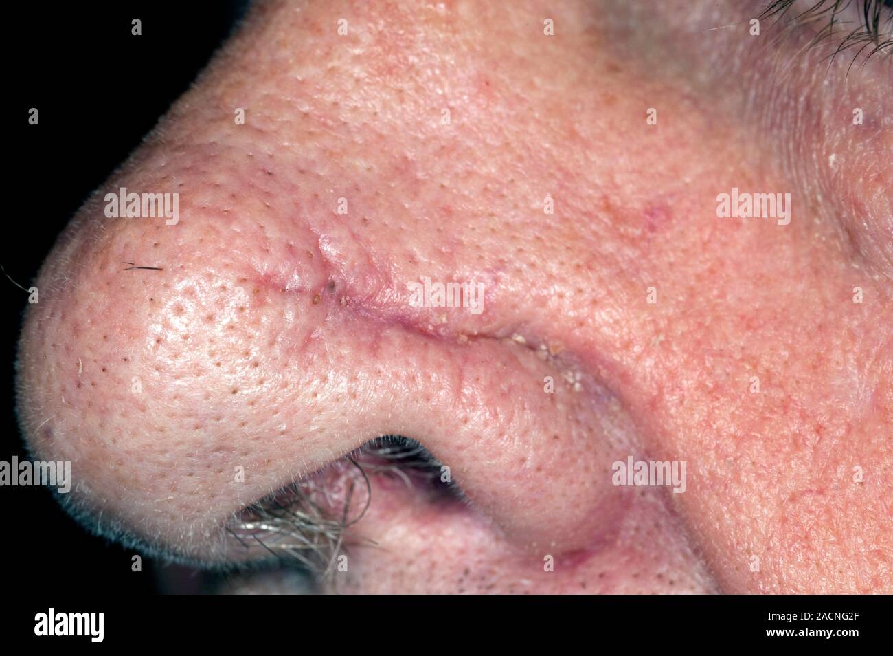 Scar on the nose in an 80 year old male patient after surgical removal