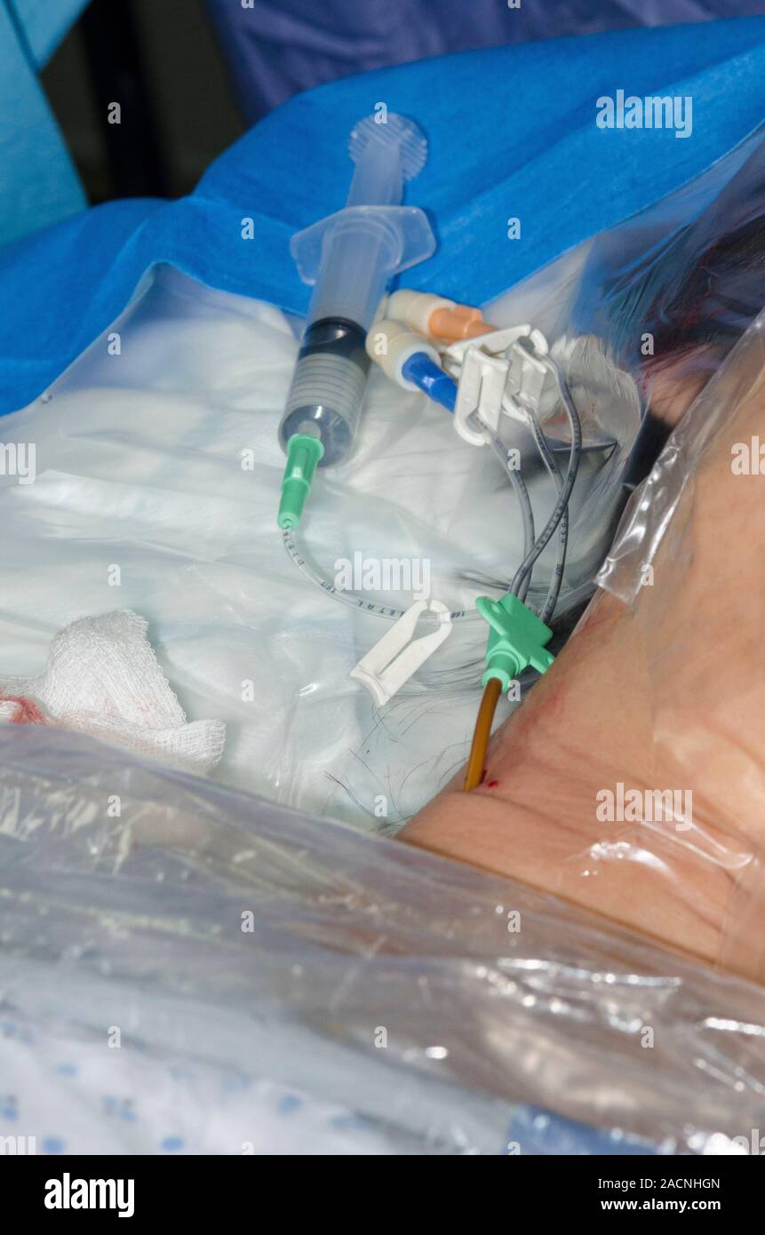 Central venous catheterisation. Central venous catheter inserted into
