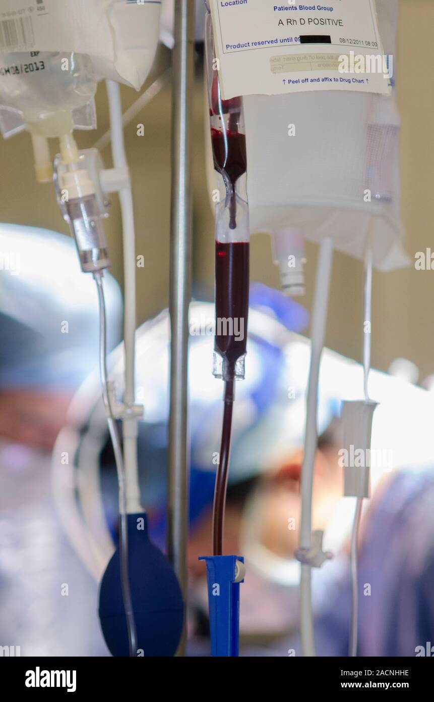 Blood transfusion. Closeup of the intravenous (IV) lines through which