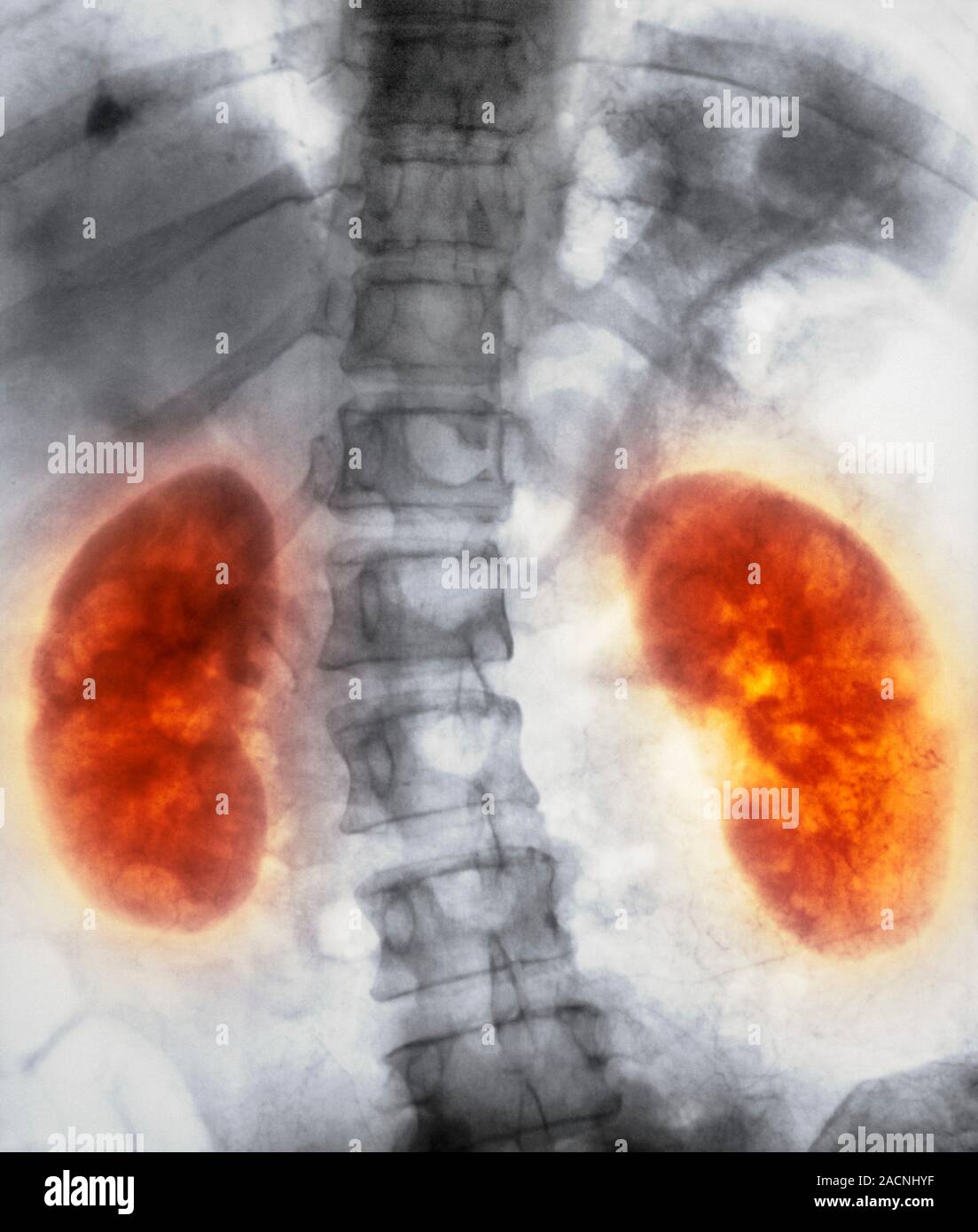 Healthy kidneys. Arteriograph (artery Xray) of the abdomen showing two