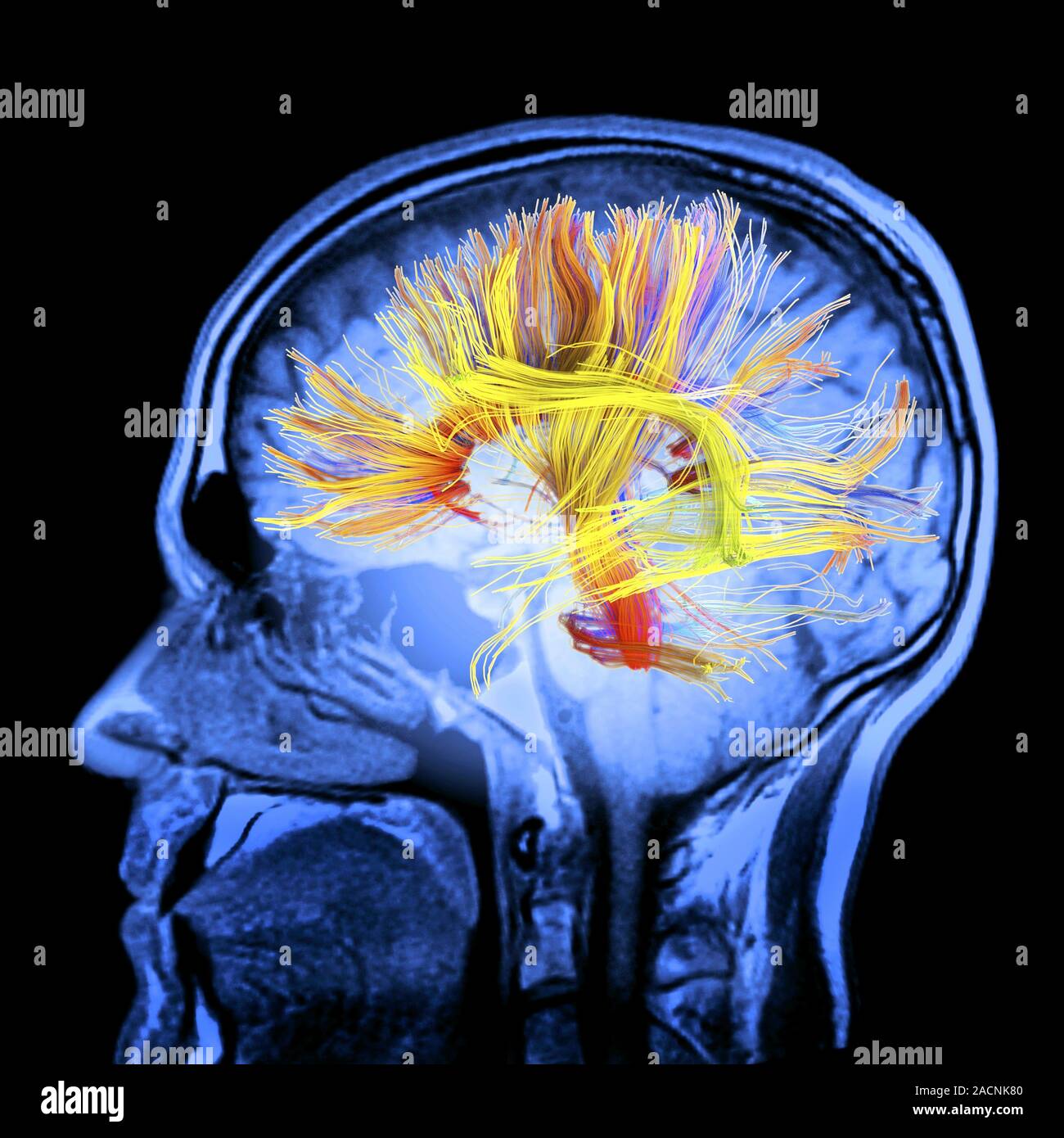White matter fibres overlaid a mri scan of the human head. Coloured 3D ...