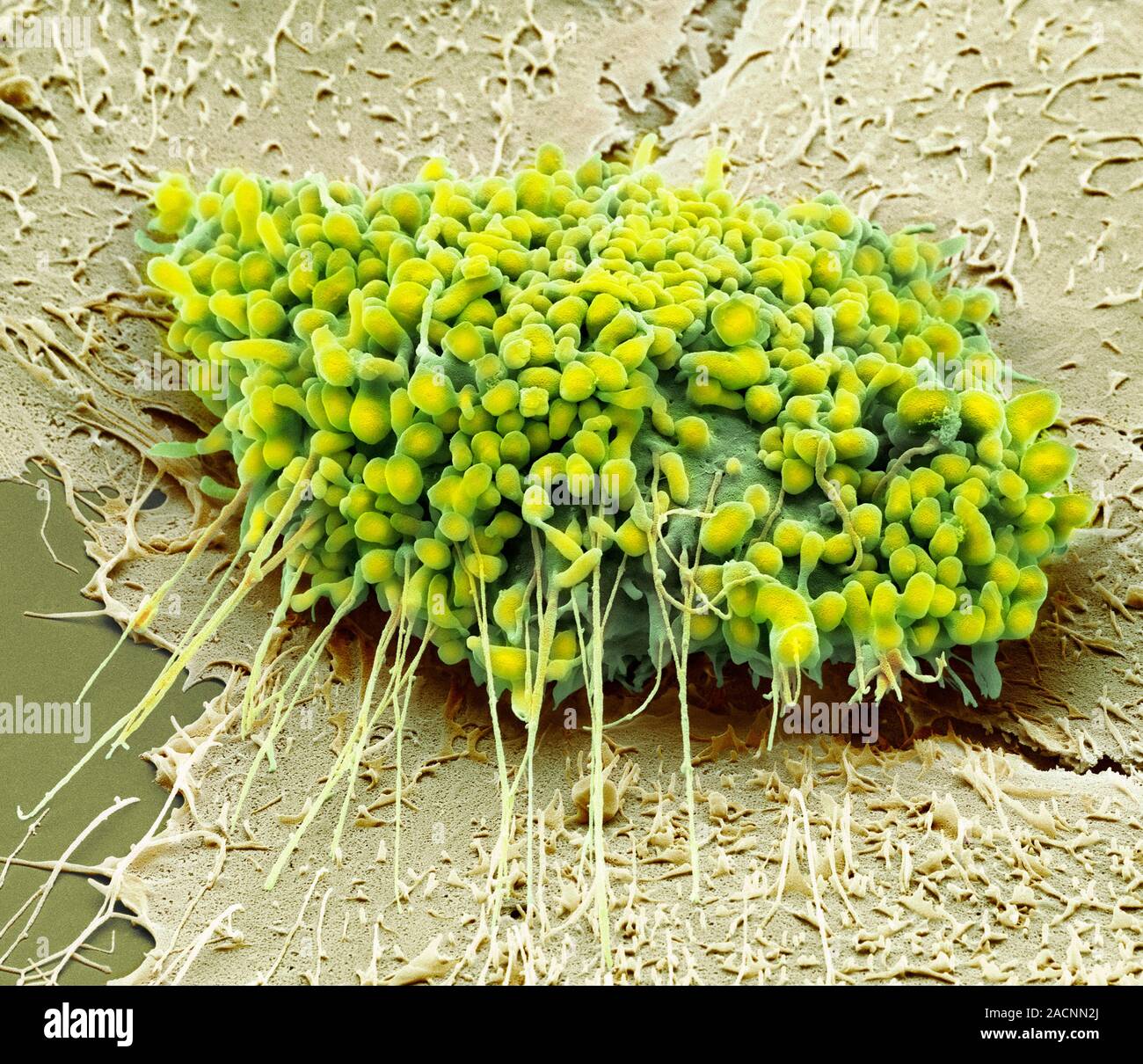Mouth cancer cell. Coloured scanning electron micrograph (SEM) of a ...