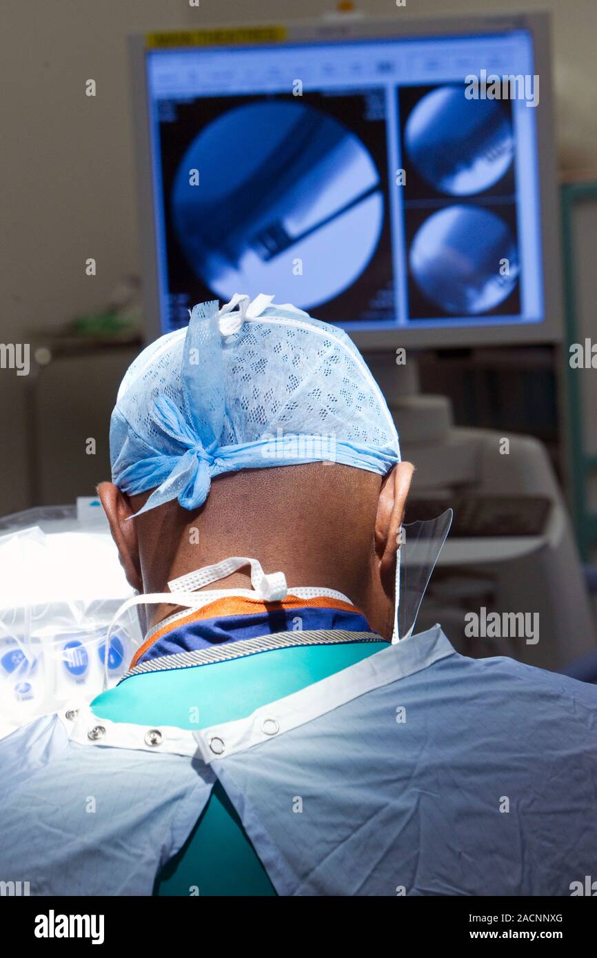 Arm fracture surgery. Surgeon using Xrays of a patient's elbow (upper