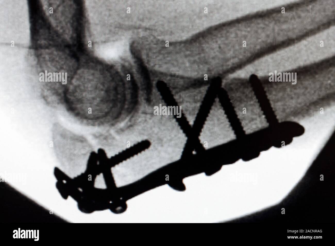 Pinned broken elbow. Xray of a patient's right elbow with plates and