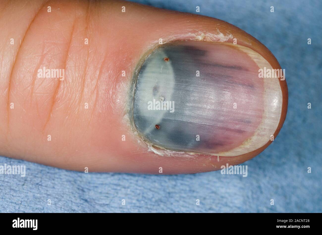 Close-up of bruising under the fingernail (subungual haematoma) in a 30 ...
