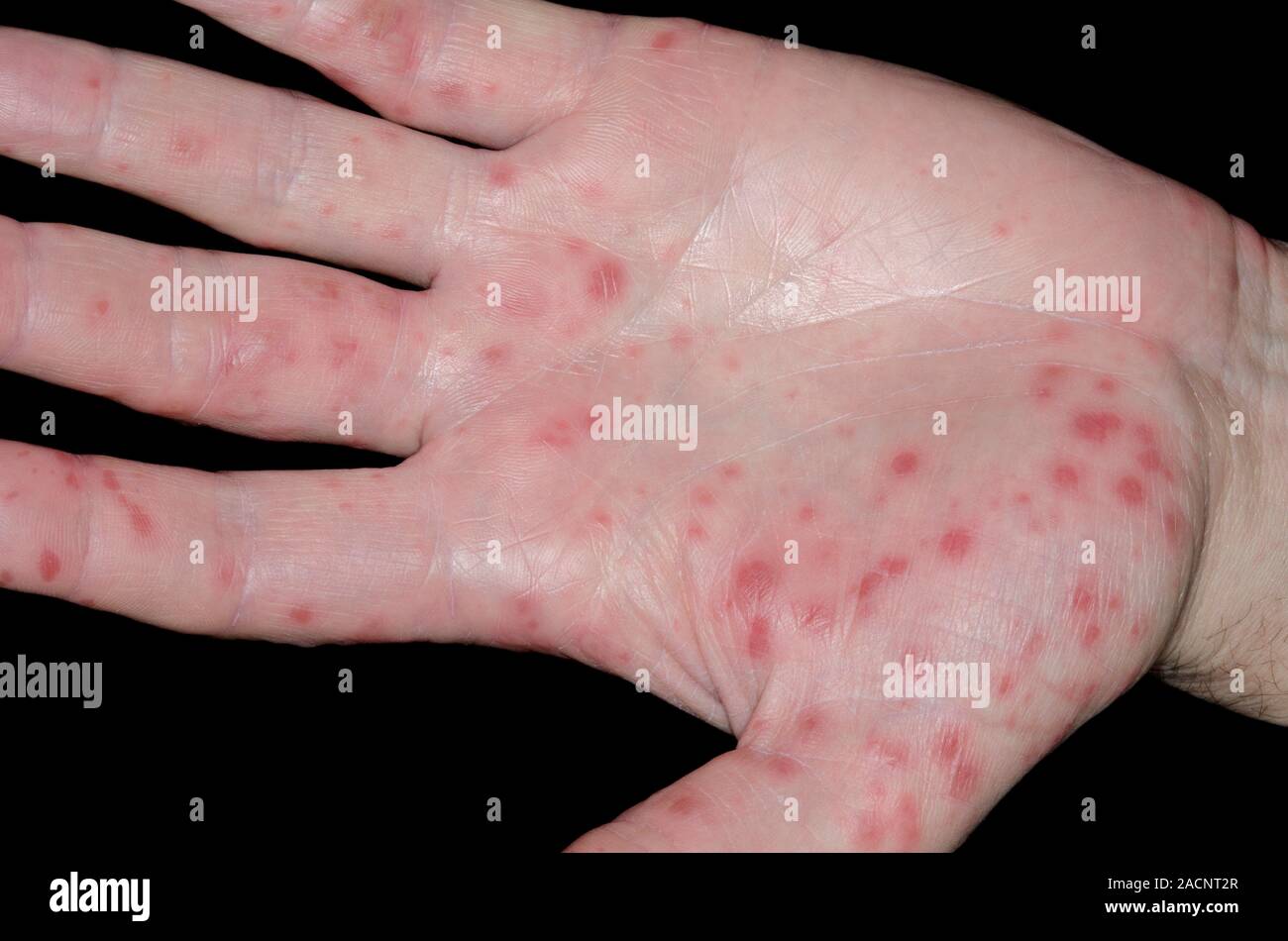 Lesions on the hand in a 41 year old male patient with hand foot and