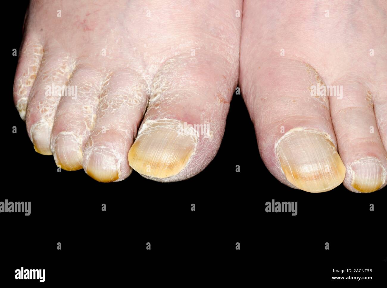 Clubbed Toenails clubbed-toenails