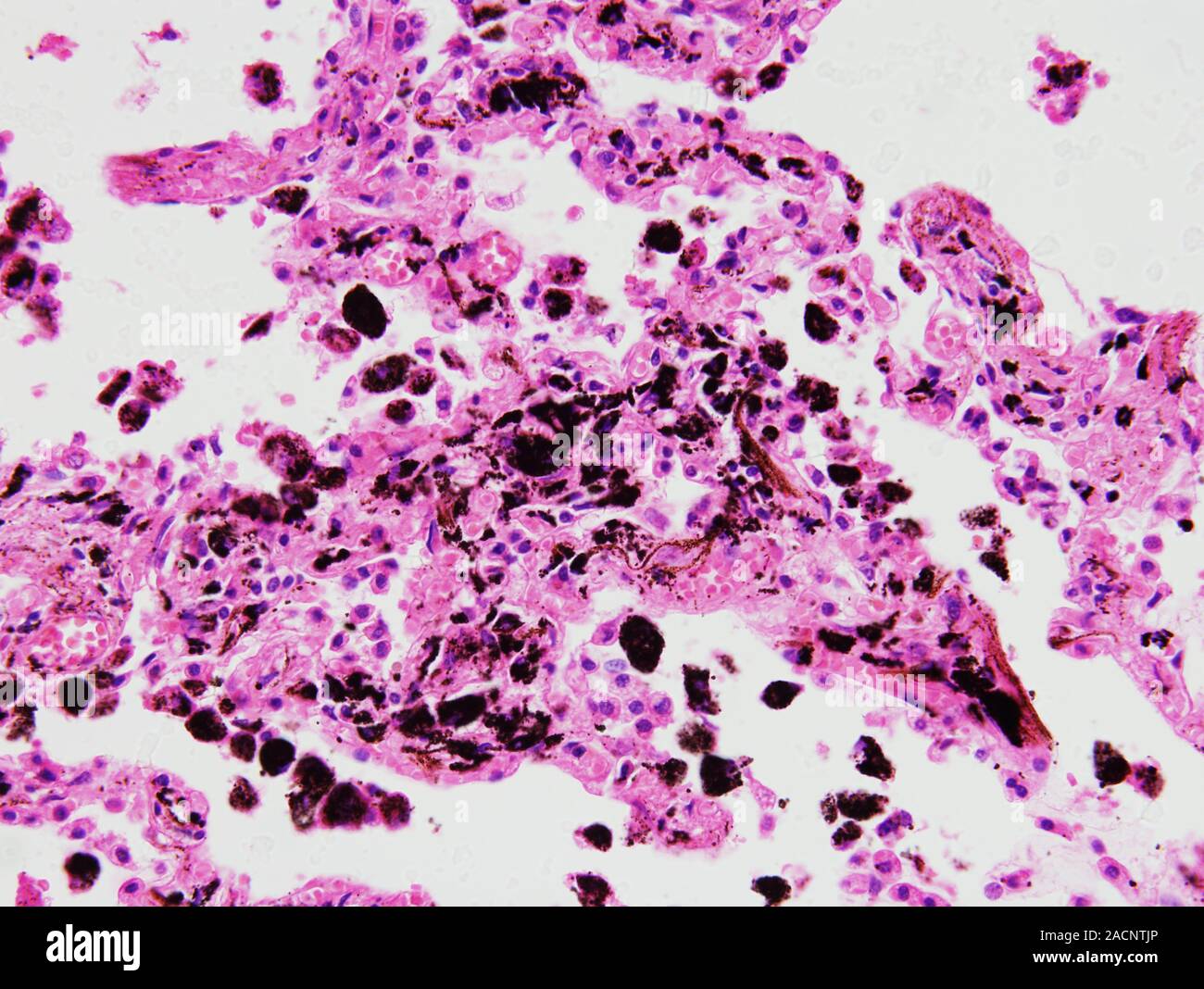 Pneumoconiosis. Light micrograph of a section through lung tissue