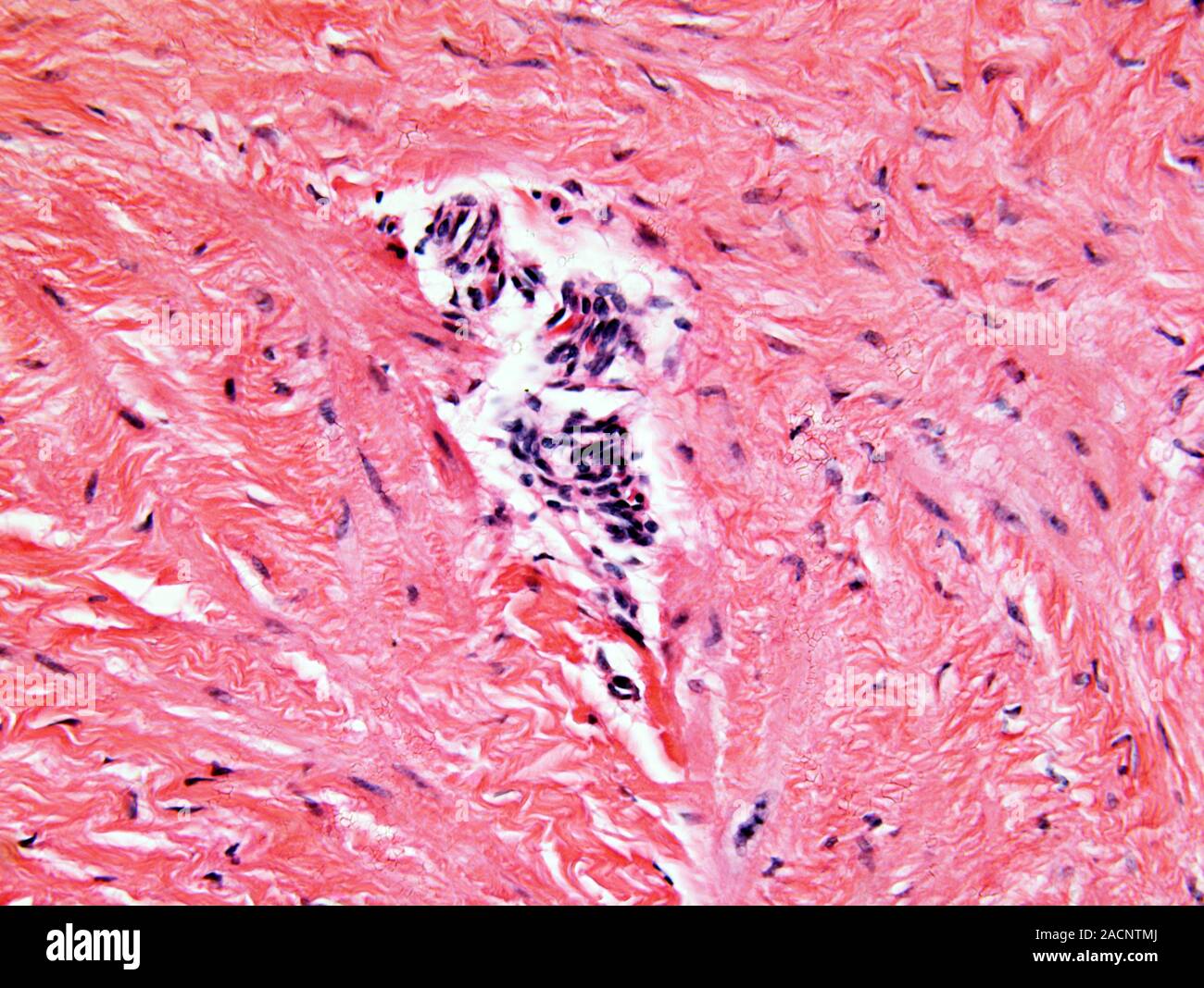 Endometriosis. Light micrograph of a section through an ovary showing ...