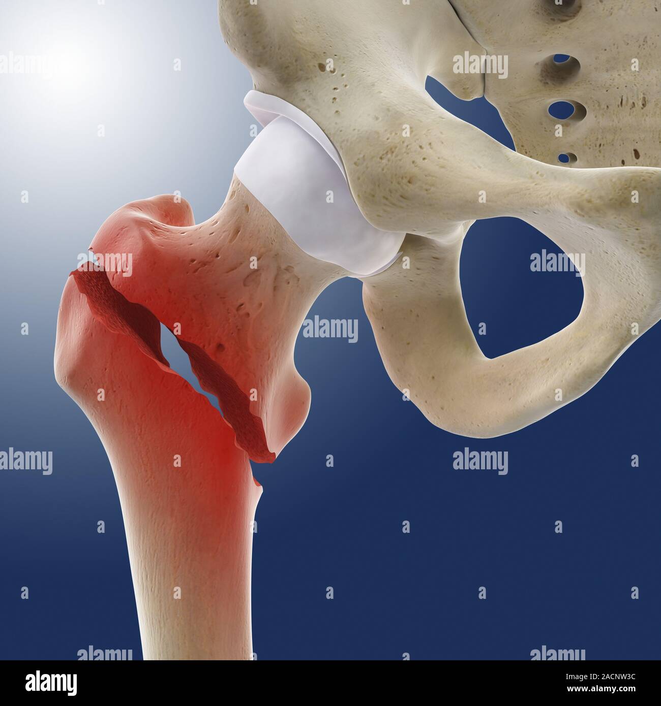 Fractured hip. Computer artwork of a fracture in the head of the femur