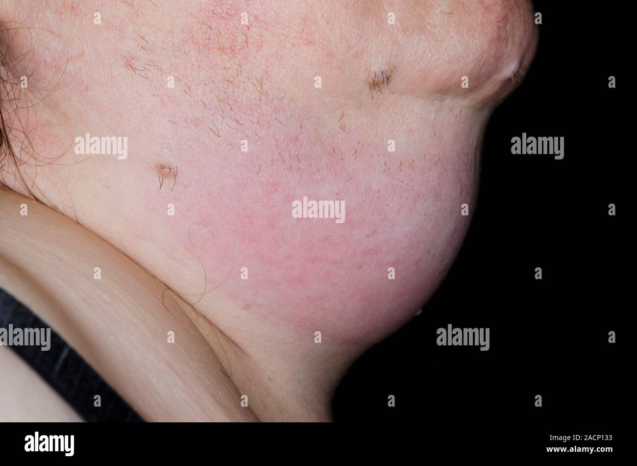 Cellulitis of the neck. Close-up of the swollen neck of a 55-year-old ...