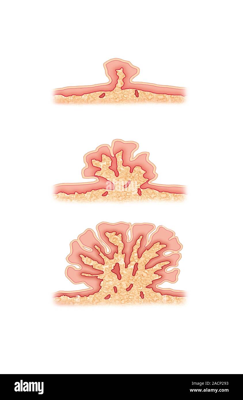 Wart. Computer artwork of a wart (Verruca vulgaris) forming on the