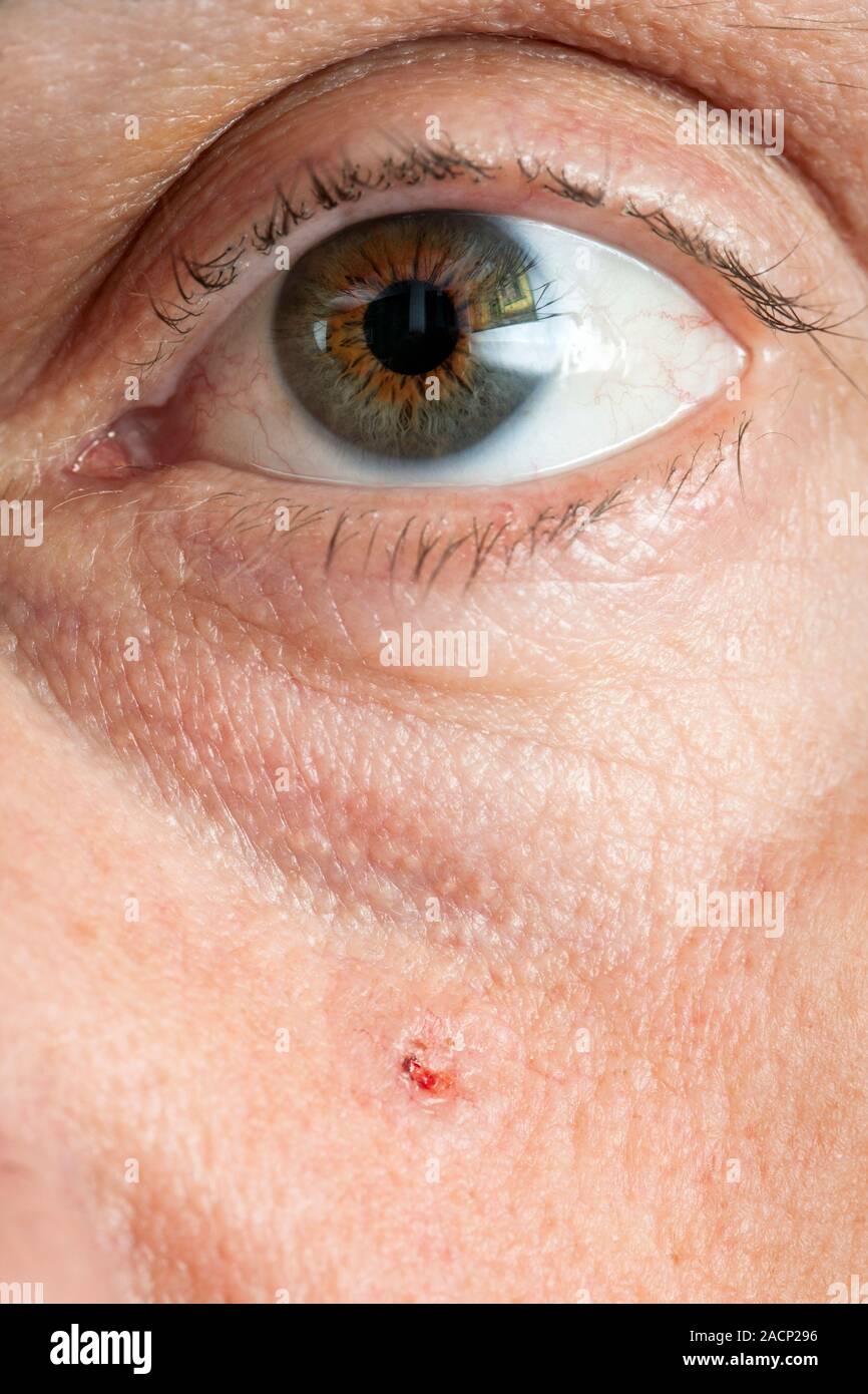 Basal cell carcinoma (BCC), or rodent ulcer, on a patient's cheek. This