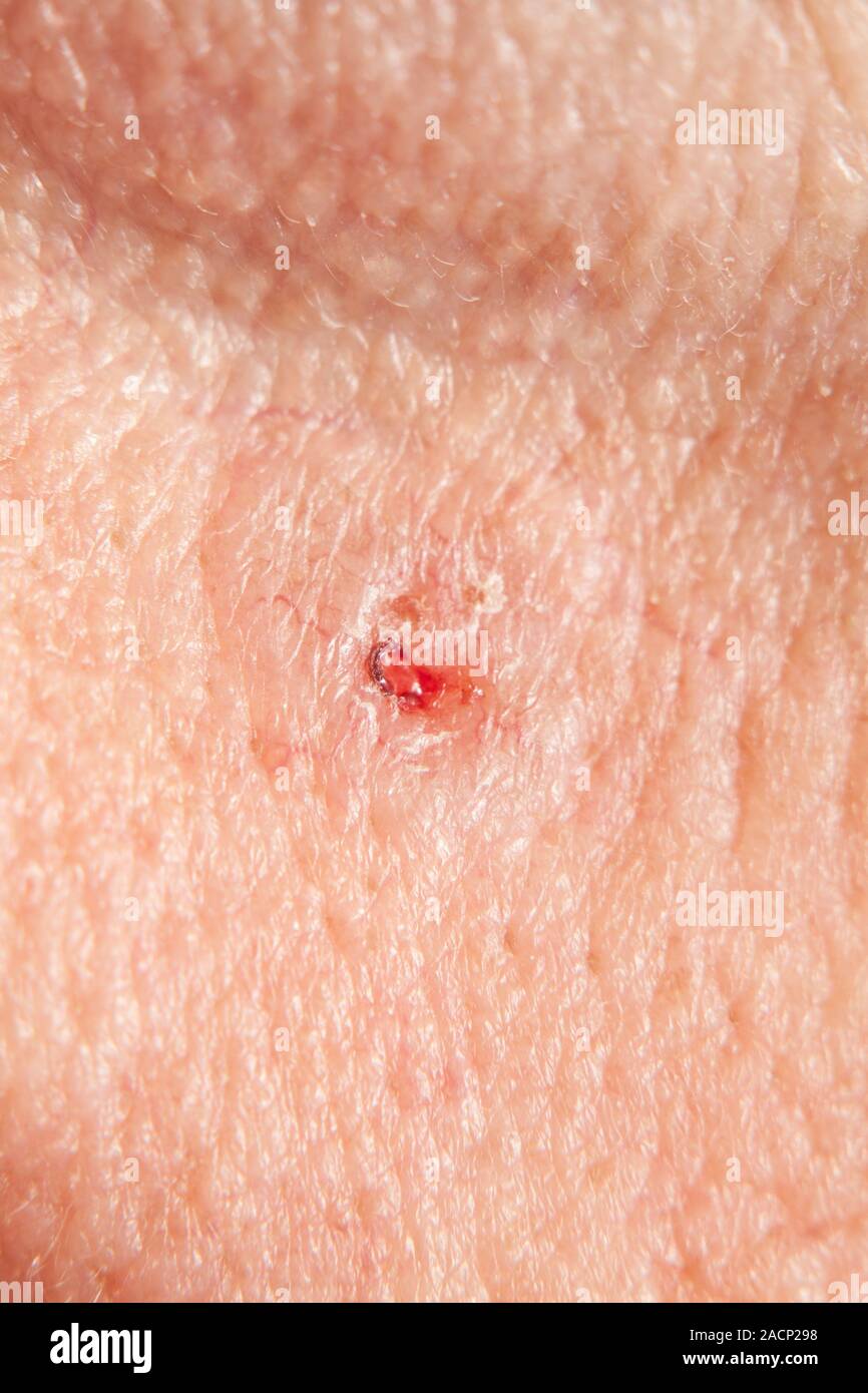 Basal cell carcinoma (BCC), or rodent ulcer, on a patient's cheek. This